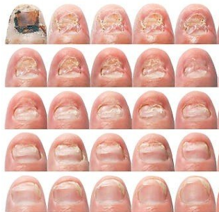 Vun Der anerer sprooch liesen op de Nägeln